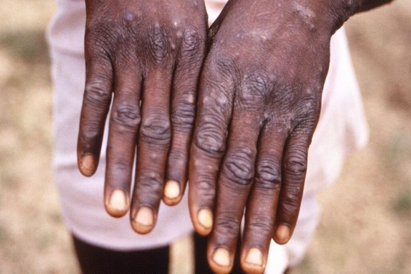 WHO deems monkeypox a worldwide health emergency