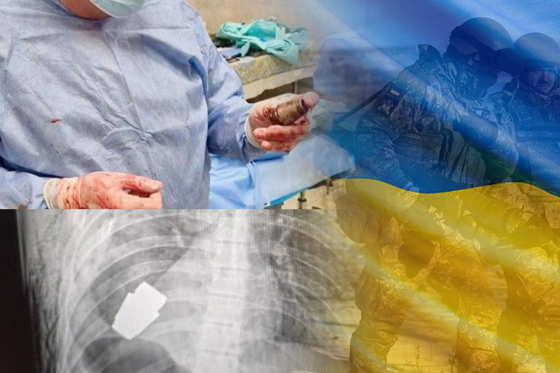  Ukrainian doctors extract unexploded grenade from soldier’s chest