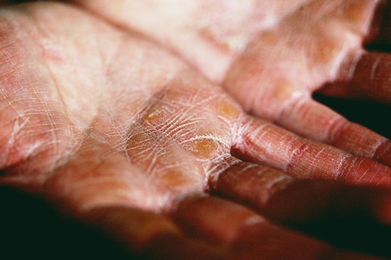 skin barrier damage