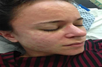 new york measles outbreak 2026