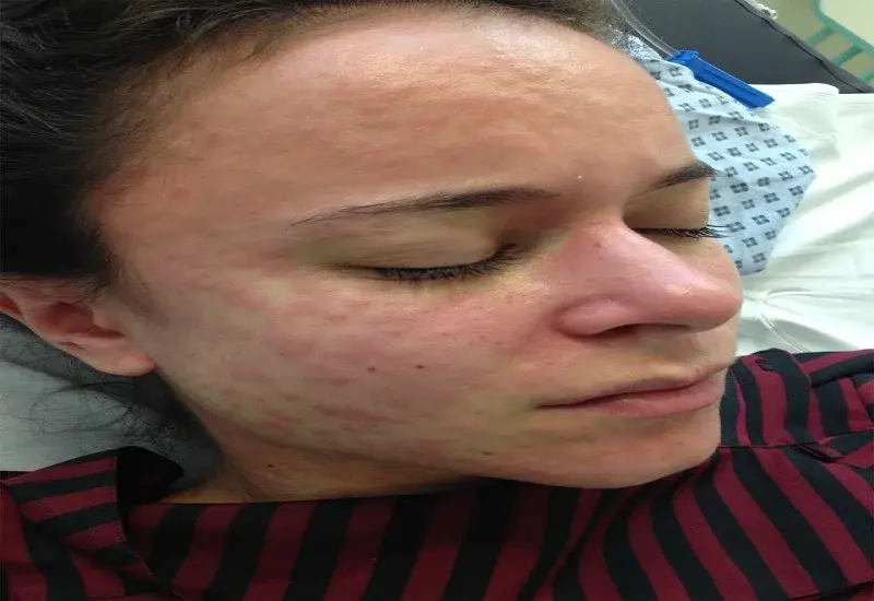 new york measles outbreak 2026